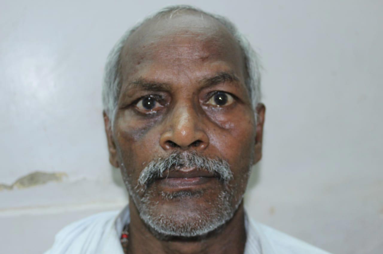 Before and after patient results with a custom artificial eye prosthesis