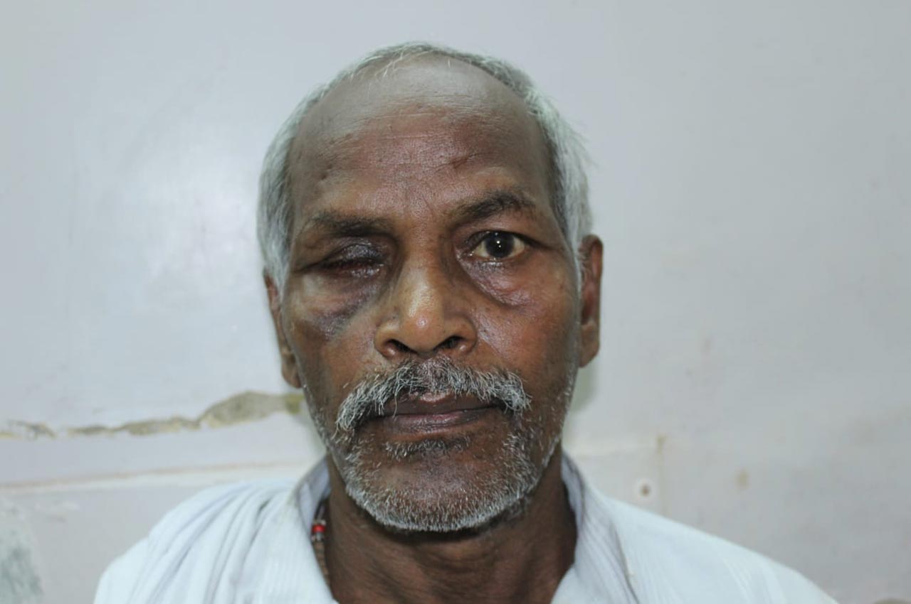 Before and after patient results with a custom artificial eye prosthesis