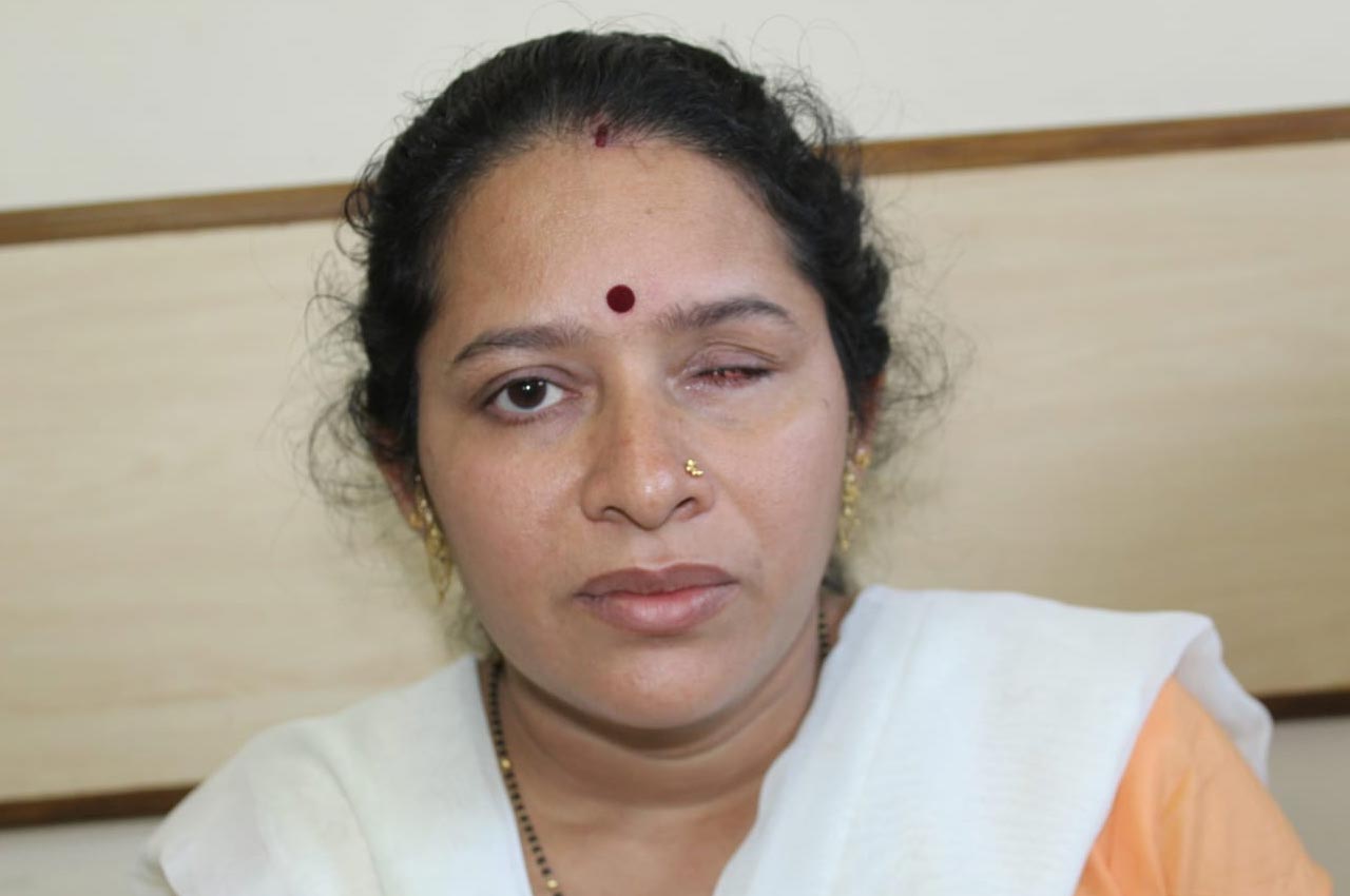 Before and after patient results with a custom artificial eye prosthesis