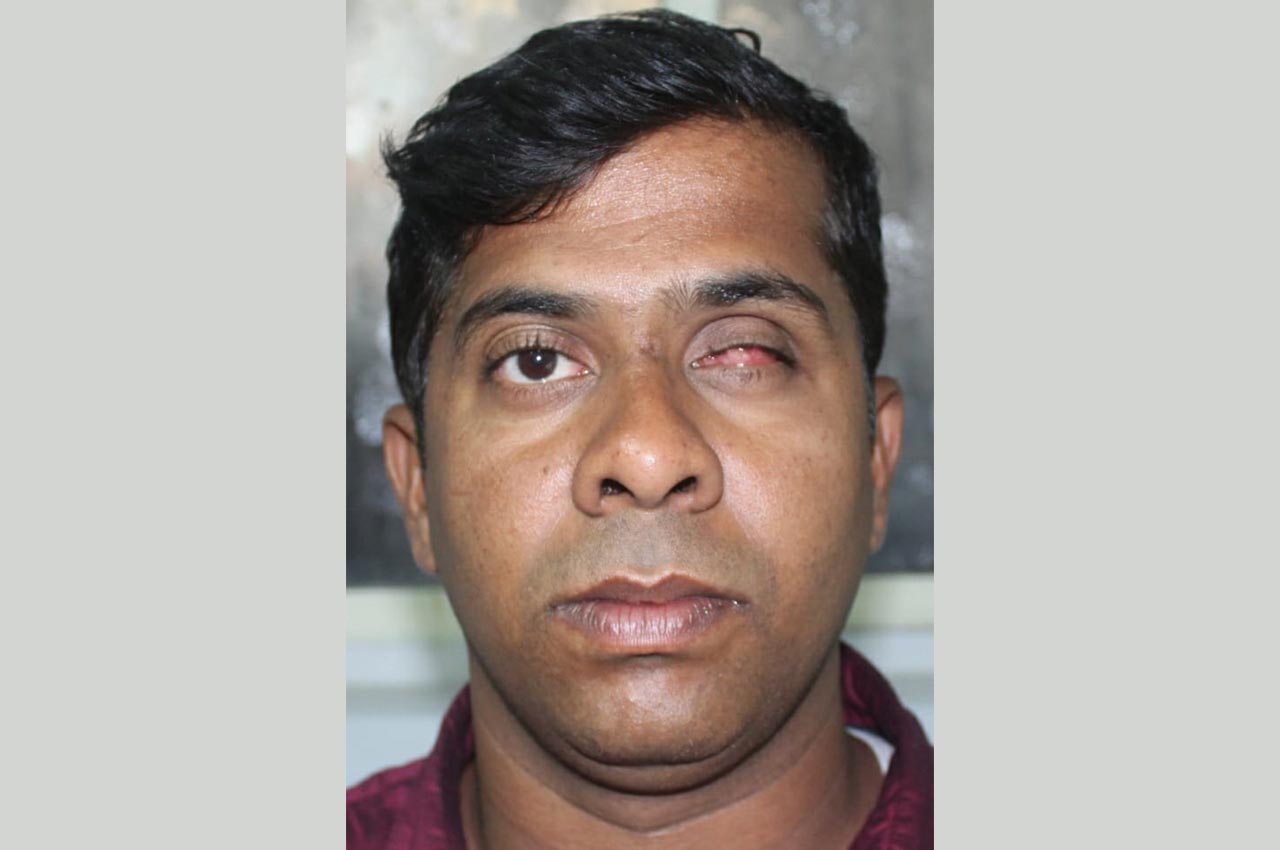 Before and after patient results with a custom artificial eye prosthesis
