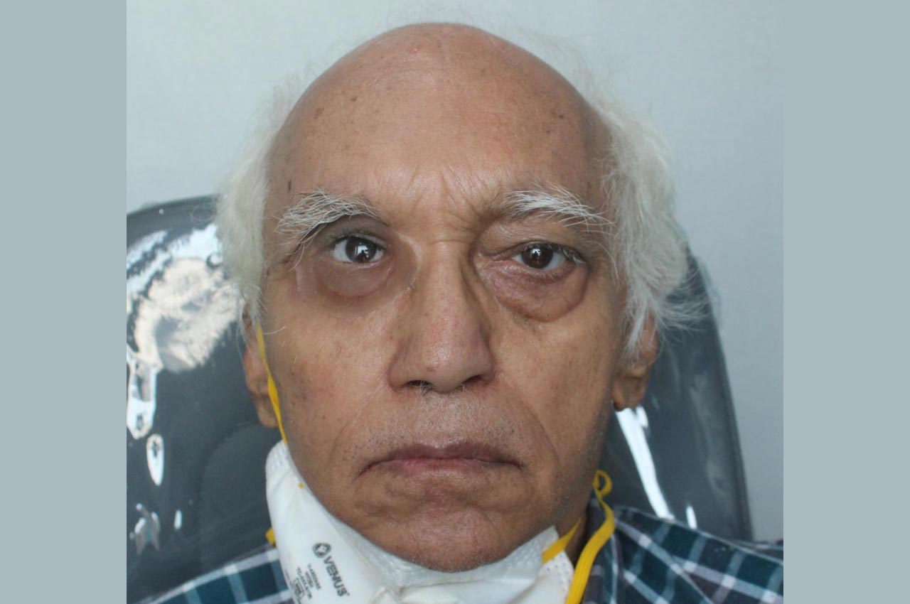 Before and after patient results with a custom artificial eye prosthesis