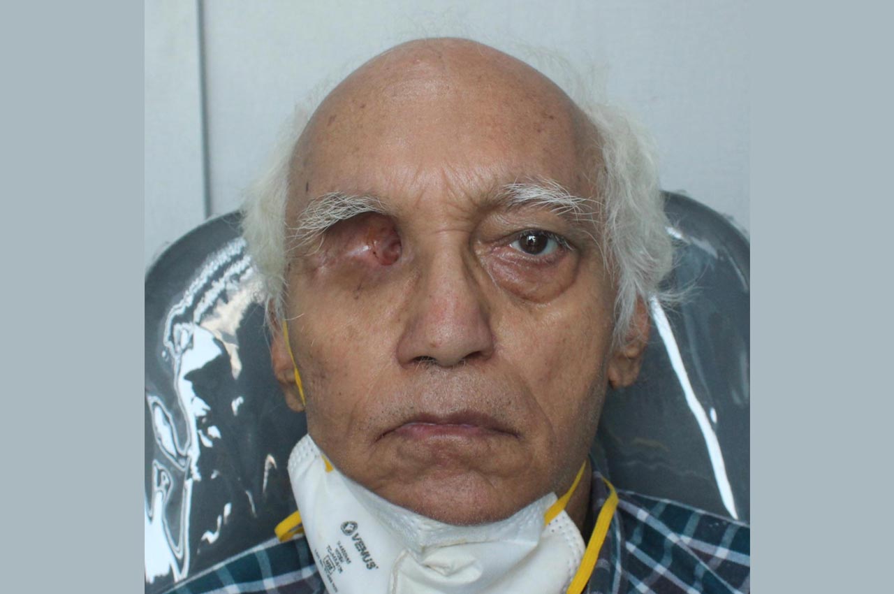Before and after patient results with a custom artificial eye prosthesis