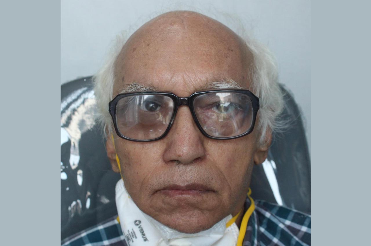 Before and after patient results with a custom artificial eye prosthesis