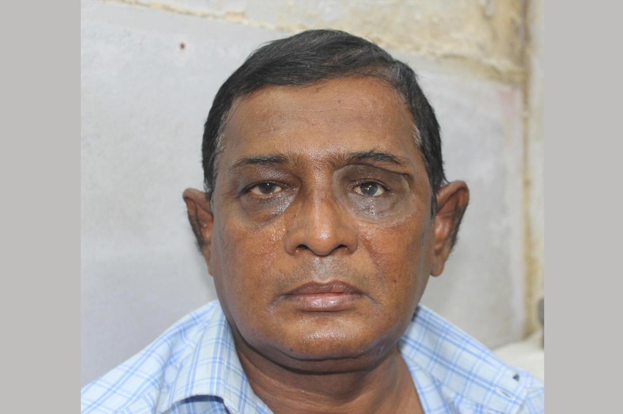 Before and after patient results with a custom artificial eye prosthesis