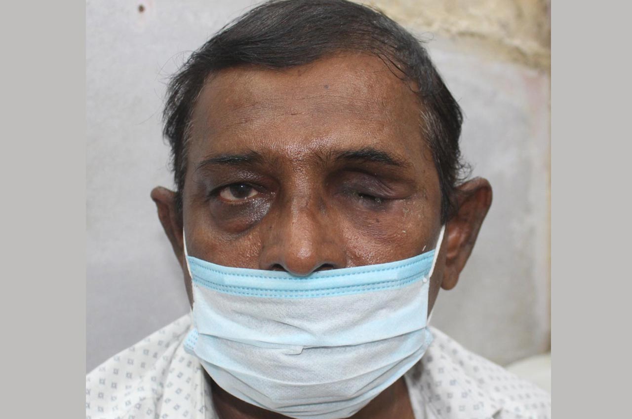 Before and after patient results with a custom artificial eye prosthesis