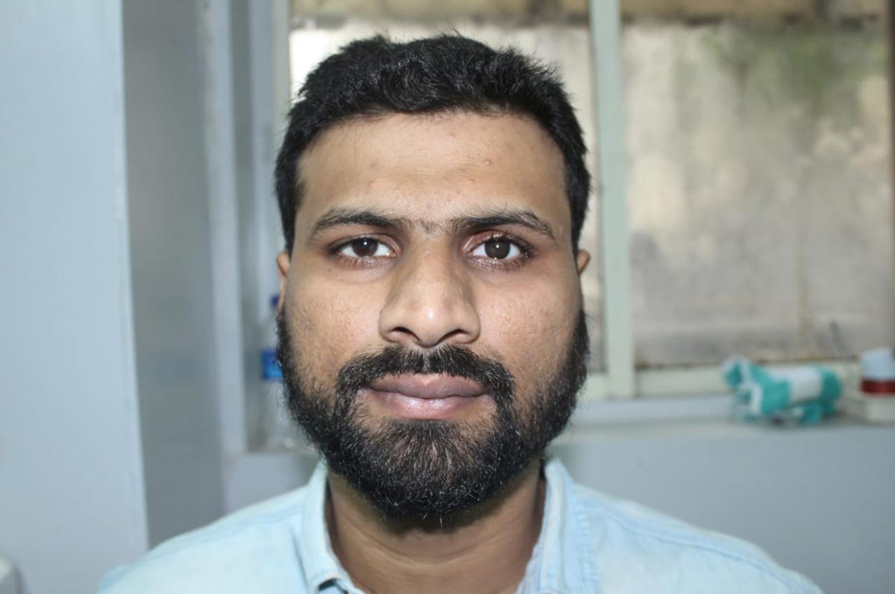 Before and after patient results with a custom artificial eye prosthesis