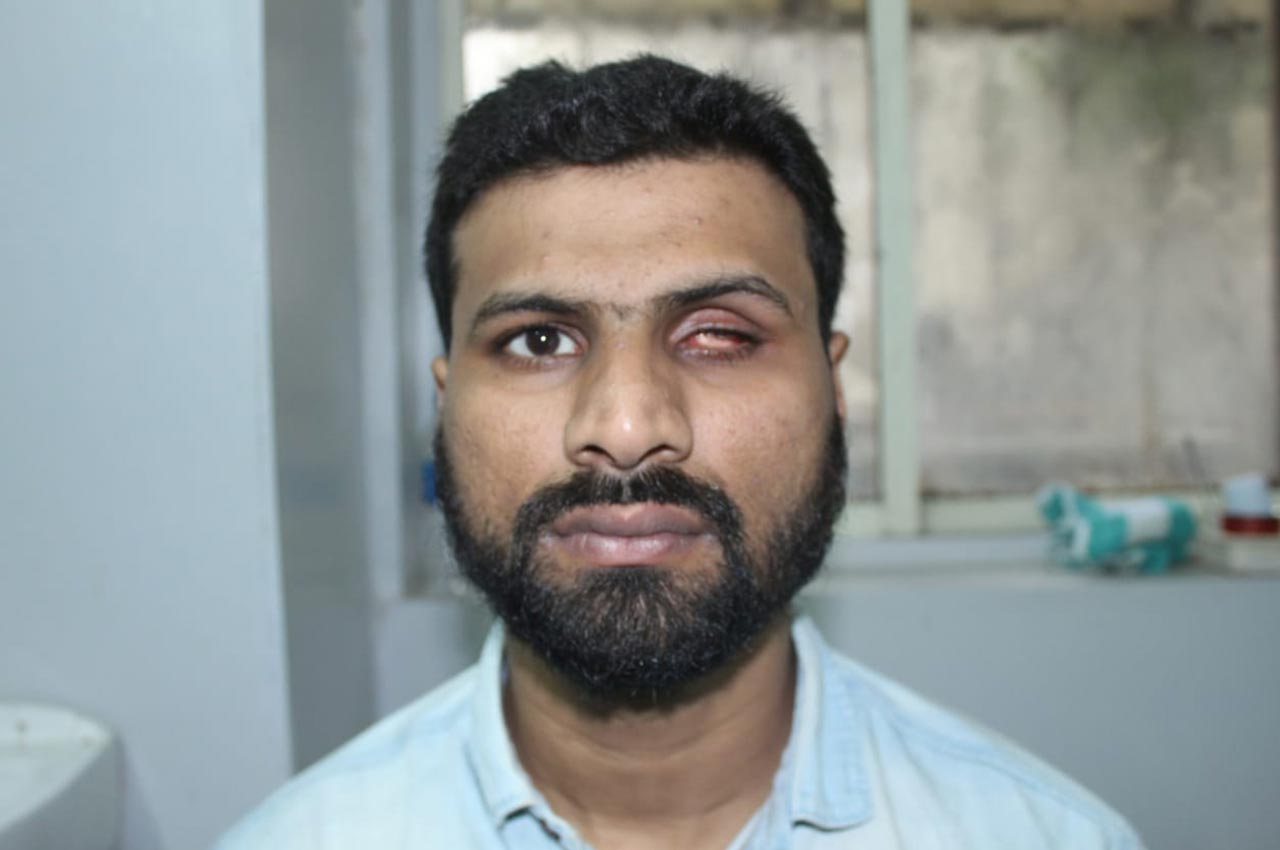 Before and after patient results with a custom artificial eye prosthesis