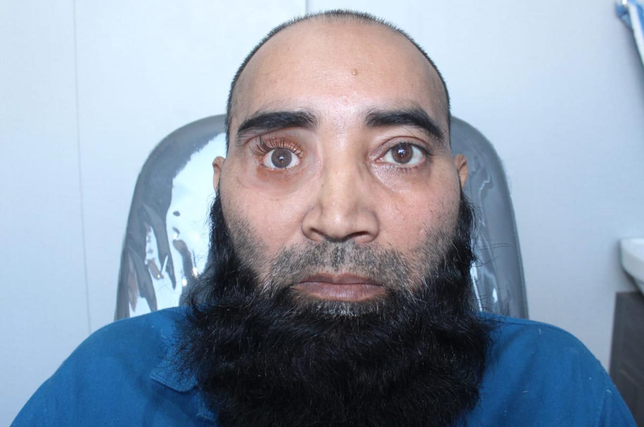 Before and after patient results with a custom artificial eye prosthesis