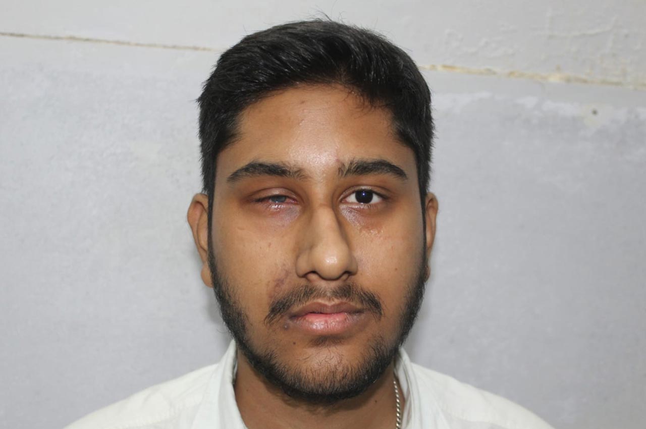 Before and after patient results with a custom artificial eye prosthesis