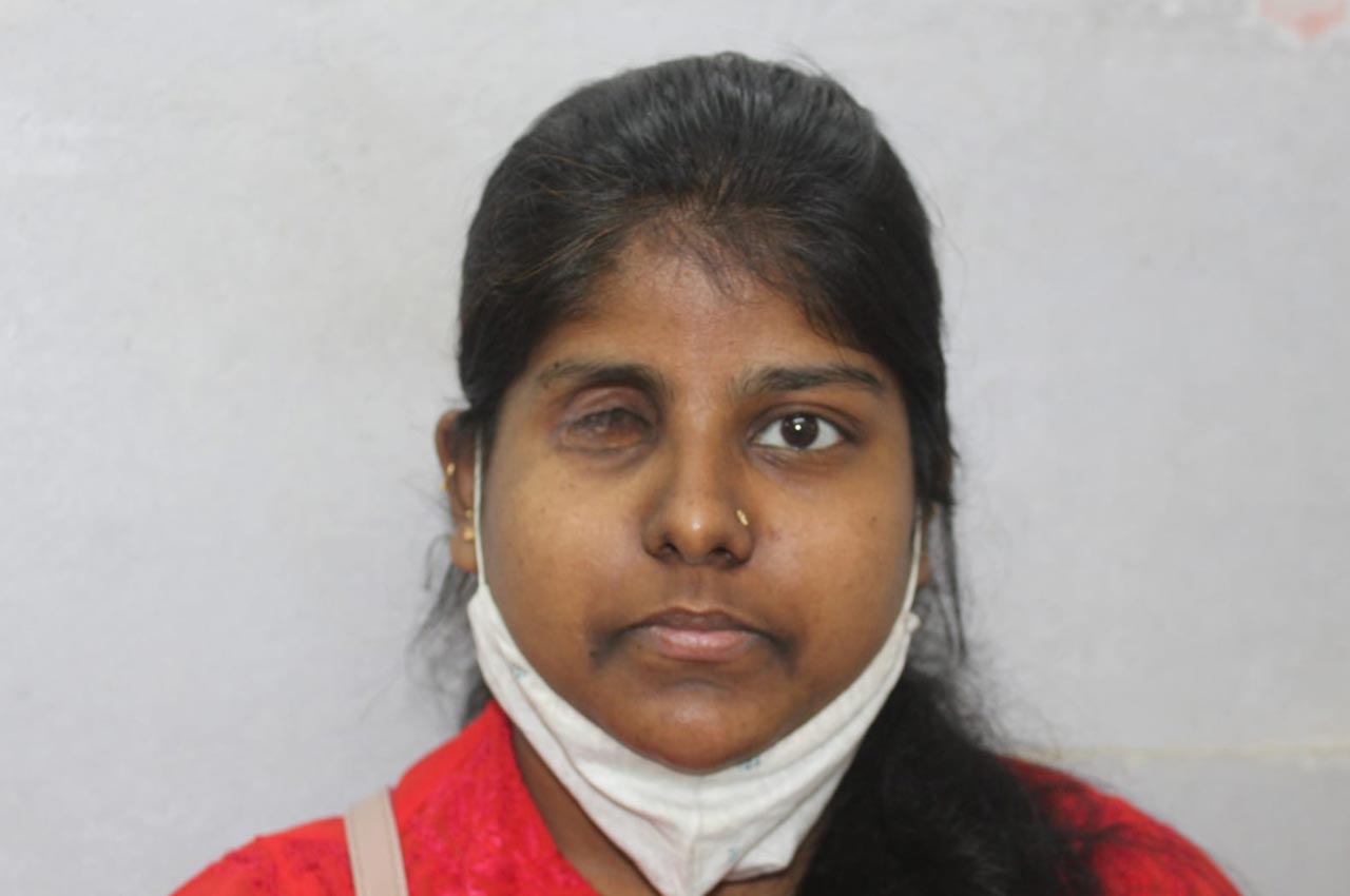 Before and after patient results with a custom artificial eye prosthesis