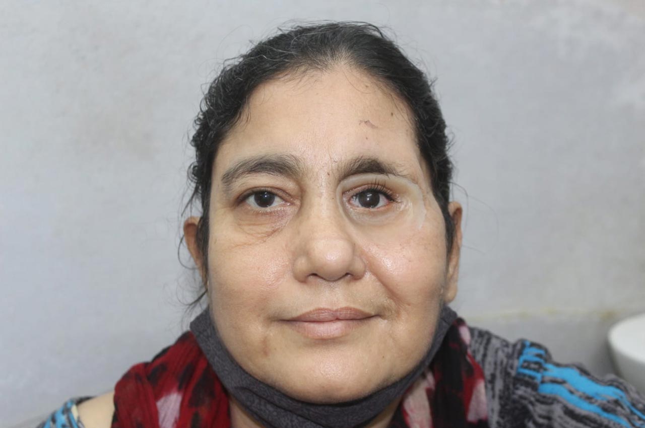Before and after patient results with a custom artificial eye prosthesis