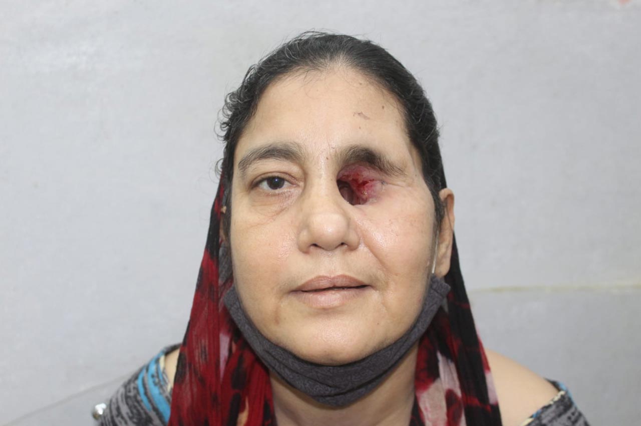 Before and after patient results with a custom artificial eye prosthesis
