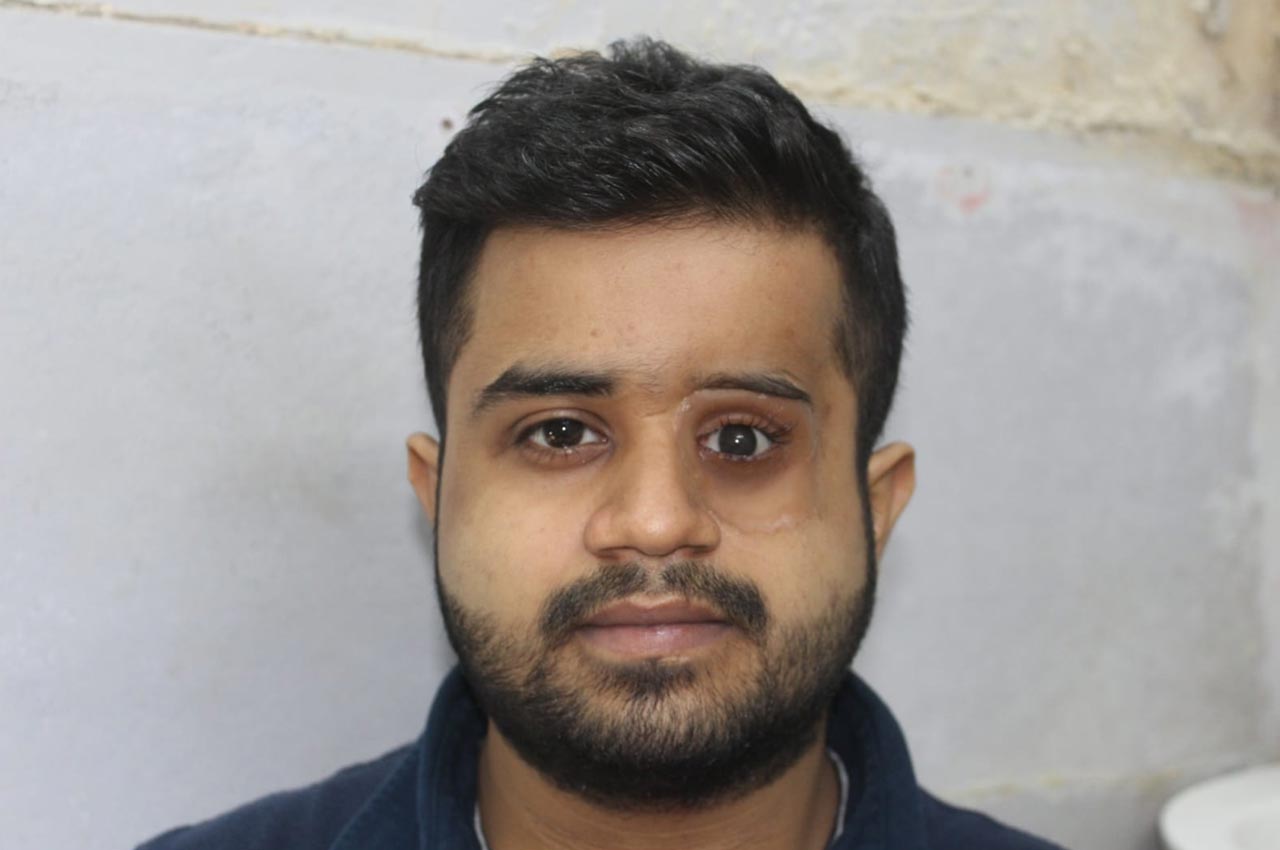 Before and after patient results with a custom artificial eye prosthesis