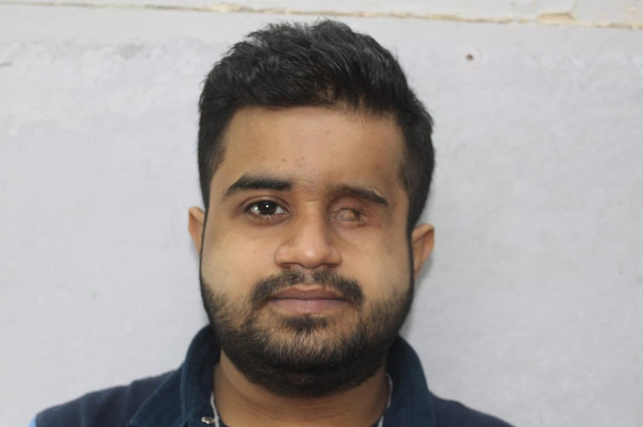 Before and after patient results with a custom artificial eye prosthesis