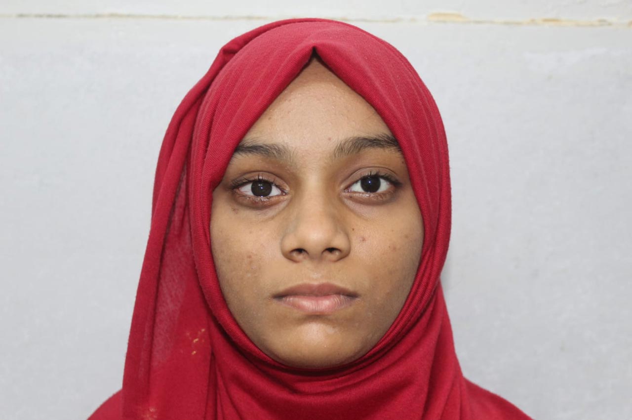 Before and after patient results with a custom artificial eye prosthesis