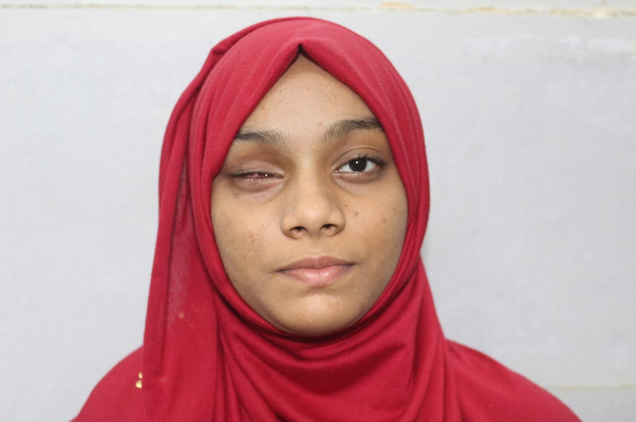 Before and after patient results with a custom artificial eye prosthesis