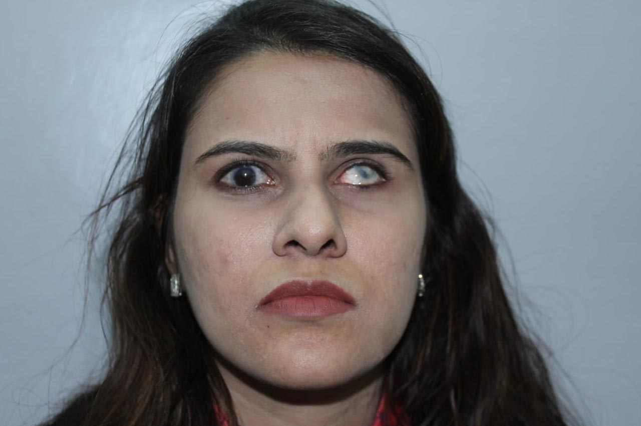 Before and after patient results with a custom artificial eye prosthesis